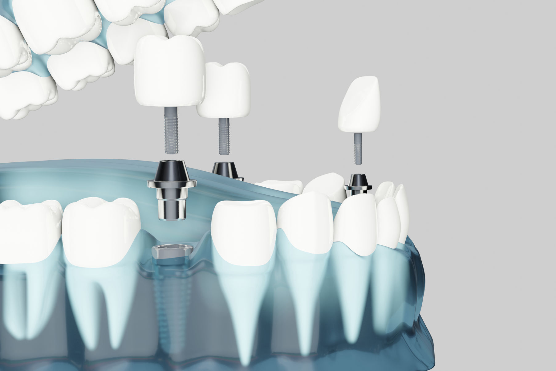 implantes el escorial