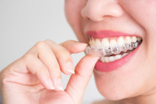 invisalign escorial